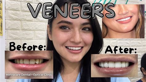 Porcelain Veneers Journey Worth It Ba Procedure Cost Experience