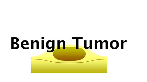 Benign Tumor: 10 Types, Symptoms, And Causes » 2025