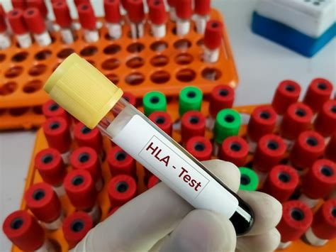 Premium Photo Human Leukocyte Antigen Or Hla Test