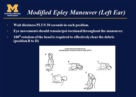 Epley Maneuver For Vertigo Left Ear