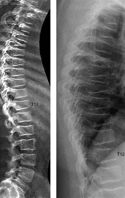 Severe Osteoporosis X Ray