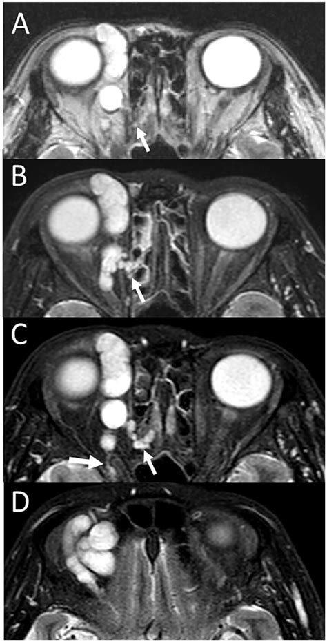 Resection Of Orbital Myxoma With Magnetic Resonance Imaging Evidence Of