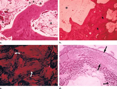 Typical Histologic Appearance Of Paget Disease A Lytic To Mixed