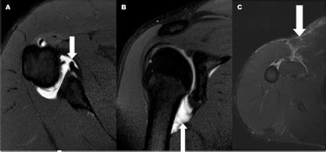 (A) Axial MRI arthrogram demonstrating the Bankart lesion; (B) coronal ...