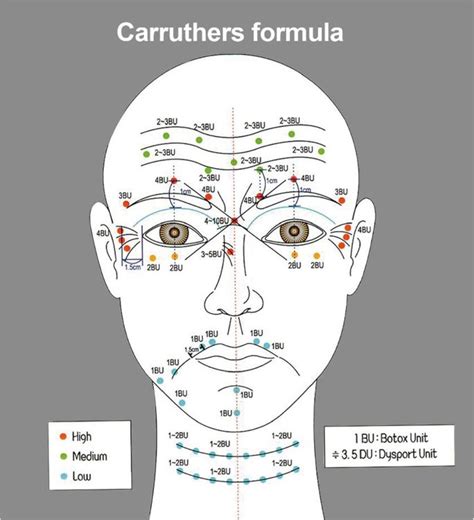 botox injection sites diagram - Google Arama | Botox face, Facial ...