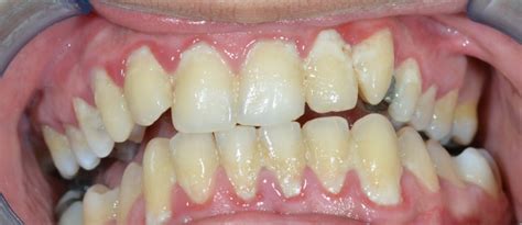 What is Dental Plaque - French Dental services - Dubai - Dr.Miski