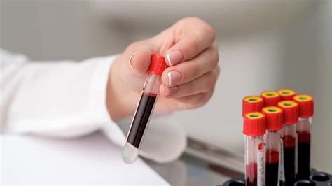 Why And When Should You Get A Hematocrit Test Onlymyhealth