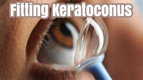 Keratoconus Part 3 Fitting Keratoconus Youtube