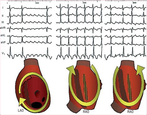 Atrial Flutter An Update Revista Española De Cardiología