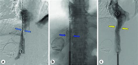 A C Ivc Venograms Which Demonstrate A Severe External Compression