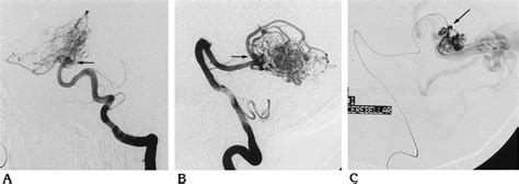 A And B Anteroposterior And Lateral Left Vertebral Angiograms