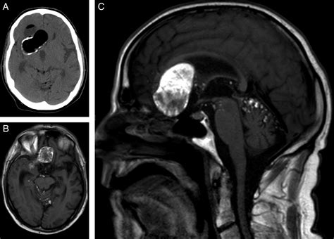 Ruptured Intracranial Dermoid Cyst Practical Neurology