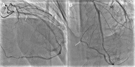 Super Dominant Left Anterior Descending Artery Continuing As Posterior