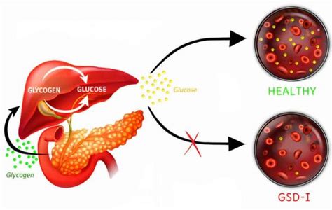 Glycogen Storage Disease Type I GSD I Von Gierke Disease