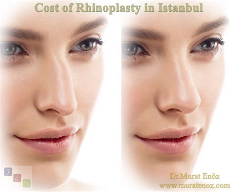 Cost Of Rhinoplasty In Istanbul Turkey