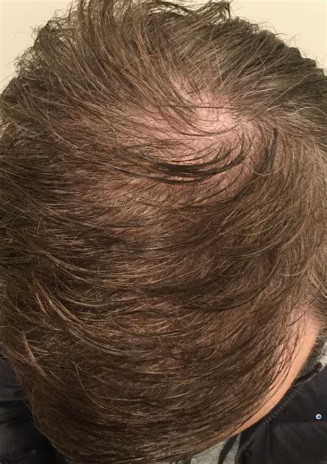 50 Year Old Male Holding On To His Hair With Finasteride And Minoxidil