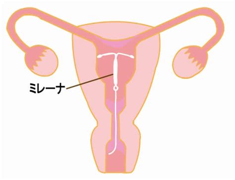 子宮内避妊器具ミレーナ・fd 1の費用・デメリットは？｜大阪・中津の婦人科