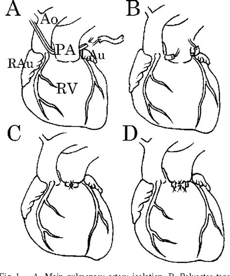 Figure 1 From Cardiovascular Effects Of Right Ventricle Pulmonary