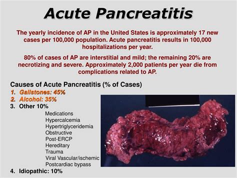 Ppt Pancreatic Diseases Powerpoint Presentation Free Download Id