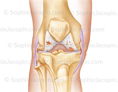 Arthrose Du Genou Illustration Medicale Sophie Jacopin