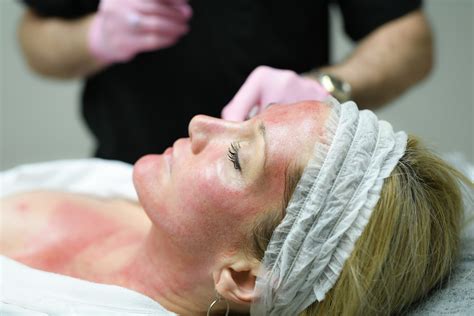 Vampire Facial In Birmingham AL Seiler Skin