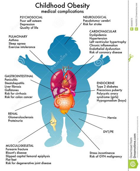 Reasons of obesity childhood | kidschildren