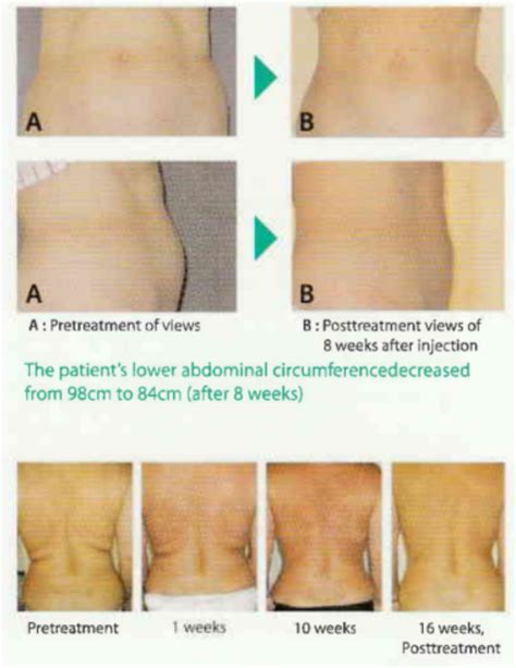 Lipo Lab Fat Dissolving Injections L Before And After Picture Results Estaderma