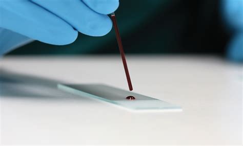 Blood Smear Procedure