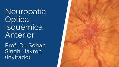 Neuropat A Ptica Isqu Mica Anterior Prof Dr Sohan Singh Hayreh De