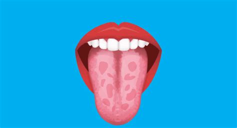 Geographic Tongue: Symptoms and Causes