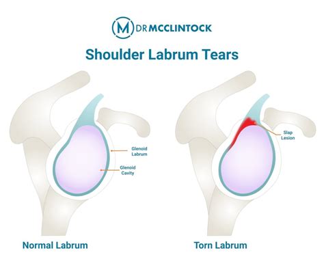What Is A Slap Repair Kyle Mcclintock Do Orthopedic Surgeon
