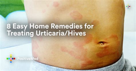 8 Easy Home Remedies For Treating Urticaria Hives Positivemed