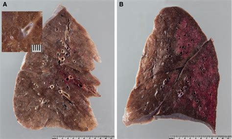 Postmortem Examination Of Covid Patients Reveals Diffuse Alveolar