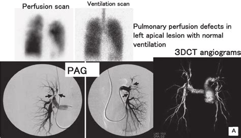 Ventilationperfusion Scans Pag And 3d Ct Angiograms In Peripheral