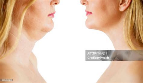 Double Chin Fat Or Dewlap Correction Before And After High-Res Stock ...