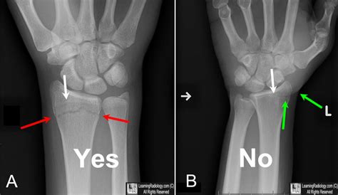 Broken Radius X Ray