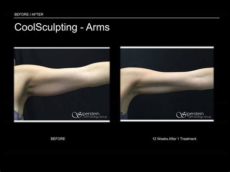 Before & After Photos Of Coolsculpting Treatment Results