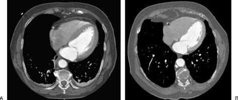 Type B Intramural Hematoma Imh Evolves To Dissection A An Axial