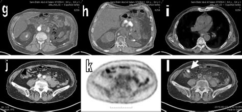 A Year Old Male Patient With Pathologically Proven Metastatic Rcc