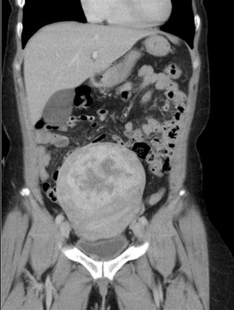 Huge uterine myoma : r/Radiology