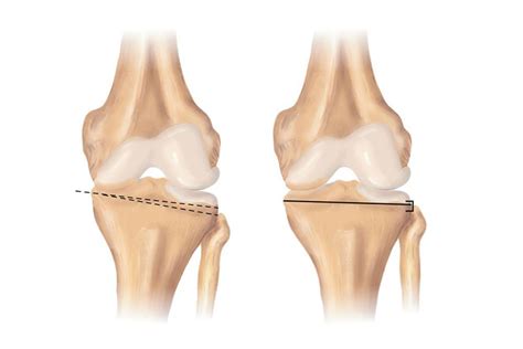 Knee Osteotomy | Rockwall, TX | Manoj Reddy