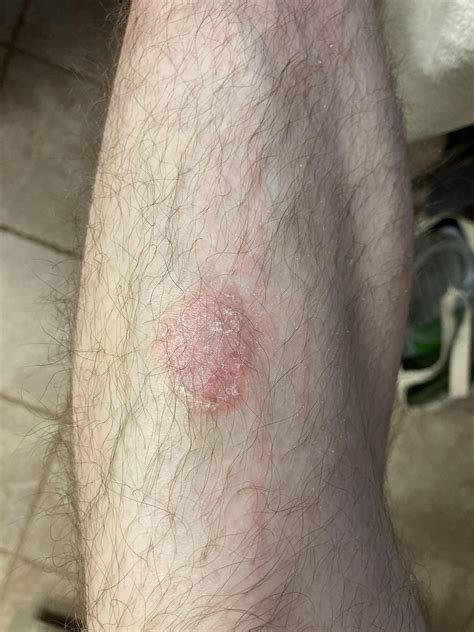 PCP thinks Psoriasis (via biopsy) - steroid cream no longer works