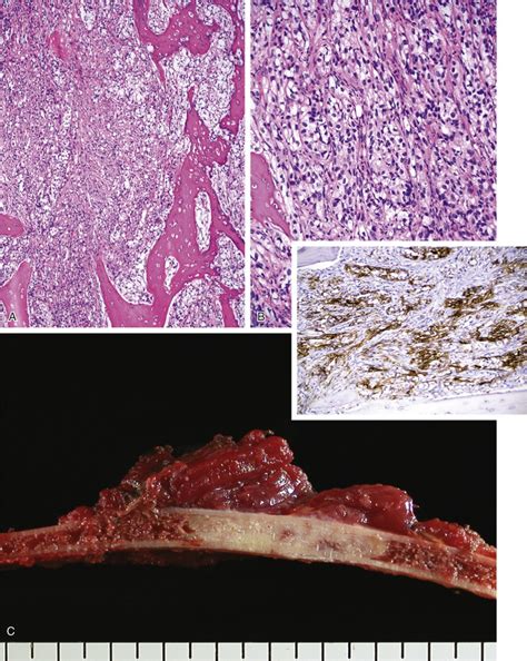 Metastatic Tumors In Bone Basicmedical Key