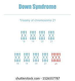 Down Syndrome Trisomy Chromosome 21 Stock Illustration 1526557787 ...