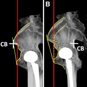 Pelvic Tilt Xray