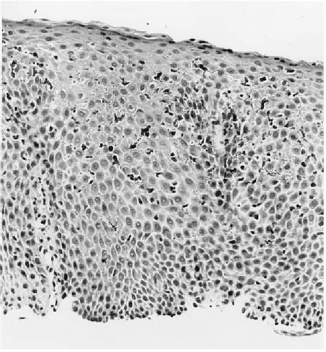 Figure 1 from Multiple esophageal rings: an association with ...