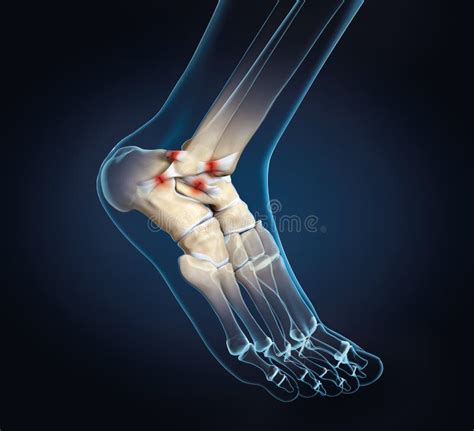 Torn Ligament in Ankle, Medically 3D Illustration Stock Illustration ...