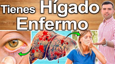 TIENES EL HÍGADO ENFERMO Y NO LO SABES Signos Y Síntomas Que Indican