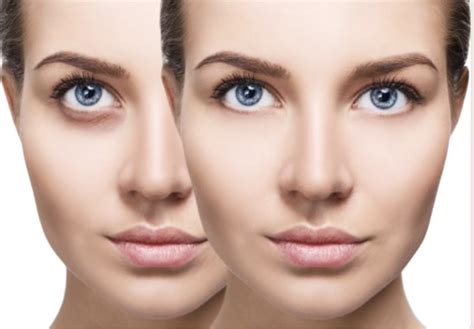 Dark Circles Removal Richmond Hill Cosmetic Clinic