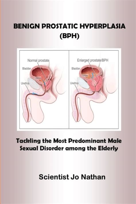 Benign Prostatic Hypertrophy Or Hyperplasia Nursing Care Off